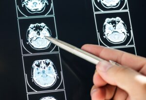 Cognitive Issues for Brain Injuries